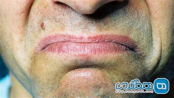 علت شیرین شدن دهان چیست؟ علت شیرین شدن دهان چیست؟