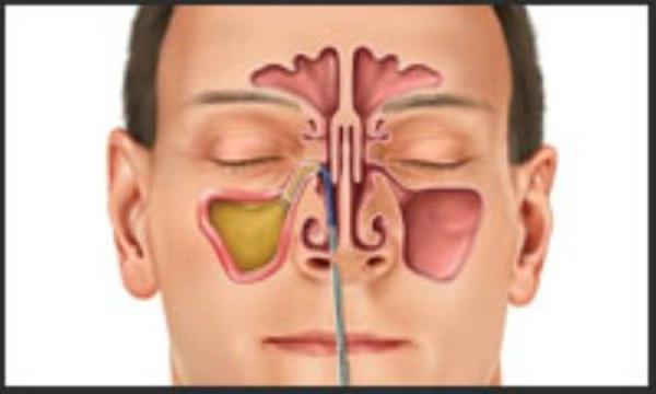 آیا عفونت سینوس مسری است؟ آیا عفونت سینوس مسری است؟